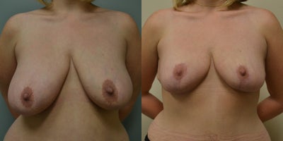 39 year old woman treated with Breast Lift - 39 year old woman treated with Breast Lift