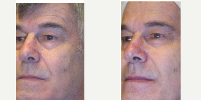 55-64 year old man treated with Titan - Male patient with a package of three Titan laser treatment is a cutting-edge procedure that helps patients achieve tighter skin while lifting and remodeling collagen to minimize wrinkles or fine lines. Titan&trade; is a revolutionary new technology from Cutera which facilitates the tightening of the skin through a non-surgical, non-ablative procedure.