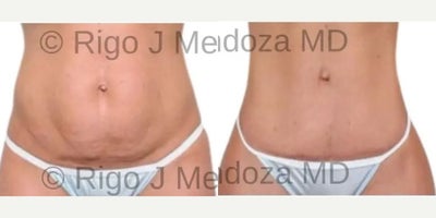 25-34 year old woman treated with Liposuction, Mini Tummy Tuck, Drainless Tummy Tuck - This procedure involves excision of the skin of the abdomen. There's no muscle repair. This patient had lipo of the abdomen and waist with a mini tummy tuck while awake with oral sedation. This was a drainless mini tummy tuck.