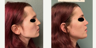 25-34 year old woman treated with Brow Bone Reduction, Forehead Reduction, Brow Lift, Rhinoplasty, Lip Lift - this is a young lady who under forehead reconstruction, septorhinoplasty, lip lift, and anterior mandible/chin feminization.