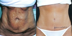 Panniculectomy - Panniculectomy