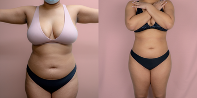 25-34 year old woman treated with Liposuction - This patient wanted only to have liposuction of her back. She is shown 2 months post-op and as you can see, the limited liposuction of her back alone still created an impressive difference in her overall shape even from the front.