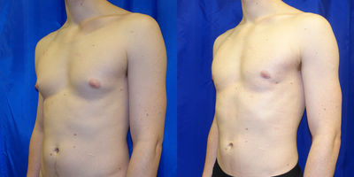 25-34 year old man treated with Gynecomastia Surgery - This fit 31 year old man had unwanted growth of glandular tissue in his chest. He underwent surgical removal using a liposuction-based approach, removing the fat and glandular tissue through minimal incisions, giving him a more masculine chest contour.