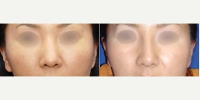 Rhinoplasty Surgery San Francisco, L Plastic Surgery by Charles K Lee - Female patient underwent Rhinoplasty in San Francisco, CA, by Dr. Charles Lee. Patient received an open rhinoplasty augmentation with a silicone implant and a tip plasty. Photos show 1 month post op. Following the procedure, the patient reported a positive experience, expressing satisfaction with the results. They wished to have a more defined and elevated nasal bridge. Dr. Lee's expertise and the support staff's care contributed to the patient's overall well-being post-surgery.