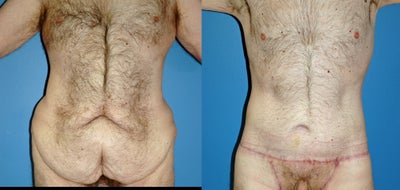 male abdominoplasty - 
	male abdominoplasty
