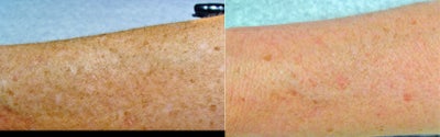 Arm discoloration improved with Fraxel laser - Fraxel laser treatment for arm discoloration