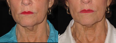 76 Year Old Female Treated with Ulthera - Patient received Ultherapy on lower face and neck for skin laxity. Photos are 4 month apart
