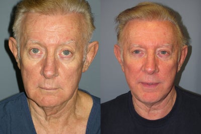 LiteLift and Brow Lift on 68-Year-Old Man - This 68-year-old gentleman received
the LiteLift&trade; and Brow Lift. To maximize the LiteLift&trade; results this patient
also had an Endoscopic Temple Brow Lift. &nbsp;The lower jowl along his jawline looks lifted.
