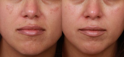 Cosmelan for Melasma - Patient was treated with Cosmelan MD (Hydroquinone) for moderate melasma on her cheeks and upper lip.