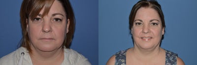 44 y/o female who underwent SmartLipo Triplex for her neck - 44 y/o female who had SmartLipo Triplex treatment to her neck.  She had a total of 100 cc of fat aspirated from the neck region.