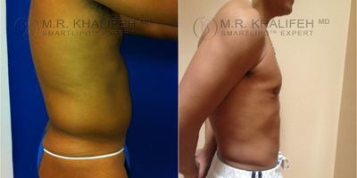 25-34 year old man treated with Liposculpture - Asian Liposuction patienthad liposuction of abdomen and lower back/flank (lovehandle) lipo to accentuate his athletic body.
