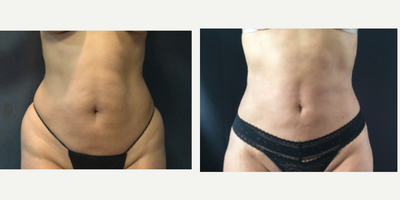 45-54 year old woman treated with SlimLipo - Smartlipo of abdomen and hips in a 53 years old female.