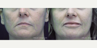 45-54 year old woman treated with Lip Implants - 45-54 year old woman treated with Lip Implants