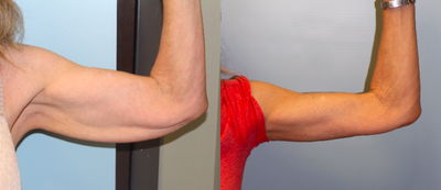 55-64 year old woman treated with Arm Lift - Arm lift performed by Dr. Bryson Richards.
