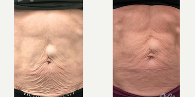 Patient treated with Microneedling RF - Incredible transformation only two months after ONE virtue Rf treatment! The Virtue RF is a Microneedling with radiofrequency treatment that stimulates collagen and elastin production, resulting in smoother, tighter skin.