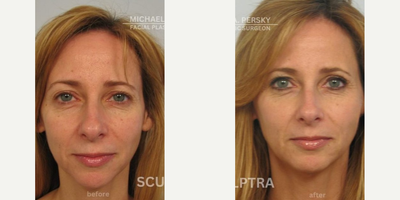 Woman treated with Sculptra - This patient received 3 treatments of Sculptra with 4 vials over a year.