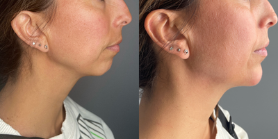 35-44 year old woman treated with Radiesse, Chin Filler - Pt treated with one syringe of radiesse for chin augmentation