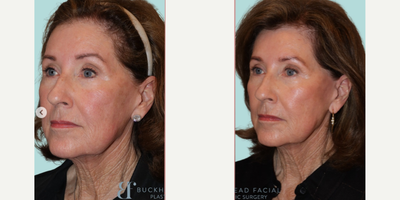 Woman treated with Emface - She used 4 treatments of #Emface, with each treatment spaced 4 weeks apart. Now, keep in mind that the result you're seeing right now is just one month after the treatment. But, typically, you can expect to see the full results in about 3 months.Just notice the texture change in her skin as well as the lift in her cheekbone and midface.