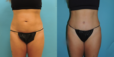 35-44 year old woman treated with Tummy Tuck, Drainless Tummy Tuck - 3 month postop from drainless tummy tuck