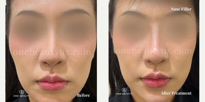 25-34 year old woman treated with Restylane Lyft - Early 30s year old treated with Restylane Lyft for Nose Filler