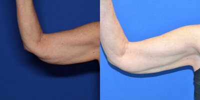65-74 year old woman treated with Morpheus8 - 70 year old female shown 6 months after BodyTite lipo to her arms combined with Morpheus8 RF microneedling.