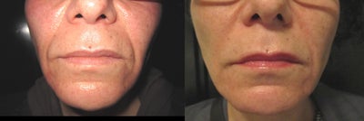 Venus Freeze of the Lower Face  - 
	45 year old female that had 6 Venus Freeze treatments of her lower face to tighten and lift the skin.
