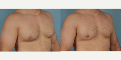 Man treated with Gynecomastia Surgery - Man treated with Gynecomastia Surgery