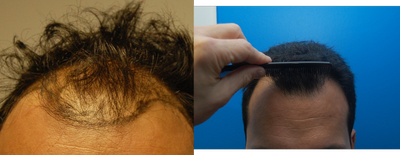 New York City Hair Transplant.  37 Year Old Male. - 
	This 37 year old gentleman presented with Norwood Class 5 Male Pattern Baldness in May of 2012, requesting surgical hair restoration. We discussed several options but because of his complexion, hair color and coarseness, we carefully chose a conservative design consisting of #1000 densely packed single hair grafts to the hairline and #1917 follicular units more posterior. The results shown are at 10 months. The final, tightly cropped photo (as well as the intra operative and marked photos) illustrate a recreated, natural, blended hairline-the result of both preserving his native frontal forelock as well as carefully supplementing it with ultra fine grafts.
