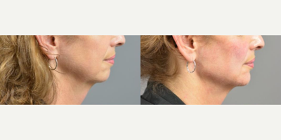 Woman treated with Dermal Fillers, Juvederm, Voluma - A Volume Lift is similar to a liquid facelift because only dermal fillers are used to achieve the desired result. Our goal with Volume Lift is to restore the youthful V shape and contour of the face by strategically, artfully and uniquely placing multiple syringes of filler using the same technique Dr. Marotta uses during a fat transfer procedure. The amount of filler needed to achieve the desired results is determined by your provider.Here is a patient who desired a more defined jawline but wasnt quite ready for surgical intervention. Our nurse injector was able to add visible contour and definition with multiple syringes of Juvederm Voluma to the cheeks, mandibular angle, pre-jowl sulcus and chin. After photo shown is immediately after injection.