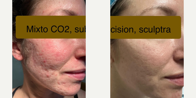 Woman treated with MiXto Laser, CO2 Laser, Laser Resurfacing - Woman treated with MiXto Laser, CO2 Laser, Laser Resurfacing