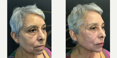 Woman treated with Restylane Lyft, Botox - Woman treated with Restylane Lyft, Botox