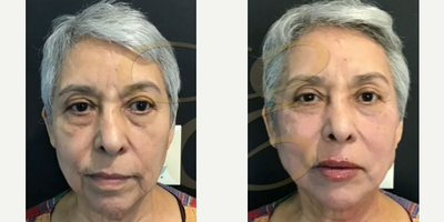 Woman treated with Restylane Lyft, Botox - Woman treated with Restylane Lyft, Botox