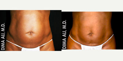 45-54 year old woman treated with Venus Freeze - This patient received 8 treatments of Venus Freeze on their abdomen. Venus Freeze is suitable for various face and body applications including circumference reduction, cellulite improvement, skin tightening and wrinkle reduction. Here we used Venus Freeze to tighten the abdomen for a flatter, more defined waistline.