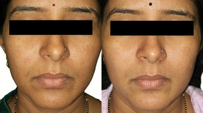 Venus Viva - Before and After 2 Treatments. &nbsp;Photos provided courtesy of Venus Concept, performed by Megha Joy Shah, MD.