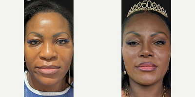 Woman treated with African American Rhinoplasty, Rhinoplasty - Our beautiful patient is shining six months post-op after an ethnic rhinoplasty and temporal/midface lift.We enhanced her dorsum with diced rib cartilage wrapped in fascia for stunning definition, and refined her tip and nostrils for harmony.The lift gave a gentle upward boost to the outer corners of her eyes and brows, creating a lively and refreshed look.