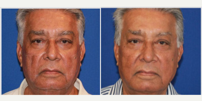 76 year old man treated with Ultherapy - 76 year old male who is only two months after ultherapy- i am posting his early treatment pictures as you can already see tightening in the neck with a more defined jawline. His marionette lines are less deep and his face appears thinner and more defined. Final results will occur over 3-4 months as new collagen forms and skin further tightens resulting in a more youthful neck and jawline.