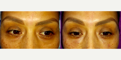 35-44 year old woman treated with Eye Bags Treatment - 38 y/o F who was looking for eye bag appearance improvement . I started the treatment 2 months ago using Tempsureenvi to tighten the skin and prepare it to hold on to the filler I injected - 1 ml of restylane silk under the eyes.