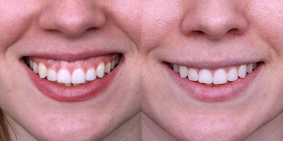25-34 year old woman treated with Botox for Gummy Smile - 25-34 year old woman treated with Botox for Gummy Smile