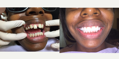 20 something year old woman treated in two visits - Patient had major spacing between her top 10 front teeth and also yellow staining on both the top and the bottom teeth along with a few other issues, including infected wisdom teeth and severe cavities in a few teeth. Her gums were healthy. After only two visits to Dr. Thompson, her smile was transformed. She had her wisdom teeth extracted while under sedation and also received a smile design (top and bottom) with all porcelain (e.max) restorations w/ no metal.&nbsp;