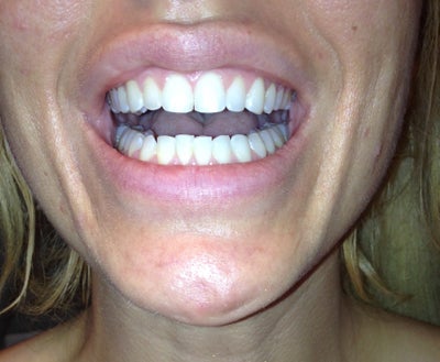 if my teeth shifted will my retainer fix it if my teeth shifted will my retainer fix it