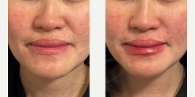 Woman treated with Juvederm, Lip Fillers - Woman treated with Juvederm, Lip Fillers