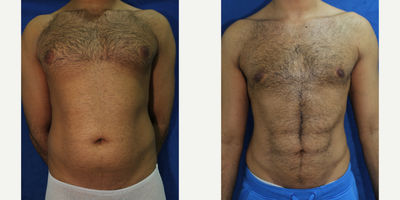 25-34 year old man treated with VASER Shape - This patient desired a six-pack abdomen and was unhappy with the size of his breasts. He was treated with Vaser Hi-Def Liposuction to contour his abdominal muscles and aspirate the excess fat from his love handles and breasts.