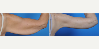 45-54 year old woman treated with Arm Lift - 49 year old post weight loss with excess skin and fatty tissue. Brachioplasty and liposuction achieved her goals