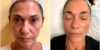 55-64 year old woman treated with Vampire Facial - RF Microneedling (Potenza) with PRP - Vampire Facial - 1 month after 1st treatment.
