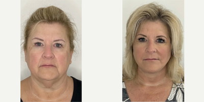 45-54 year old woman treated with Facelift, Deep Plane Facelift, Buccal Fat Removal - 53 y.o female who underwent deep plane facelift, necklift, buccal fat reduction. She was awake yet comfortable for the procedure