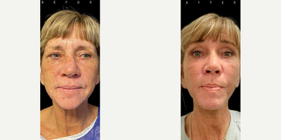 Woman treated with Facelift - Woman treated with Facelift- 1 month post-op