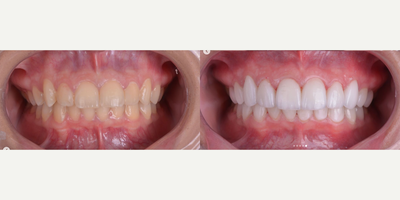 Woman treated with Porcelain Veneers, Smile Makeover - Woman treated with Porcelain Veneers, Smile Makeover