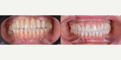 Woman treated with Porcelain Veneers, Smile Makeover - Woman treated with Porcelain Veneers, Smile Makeover