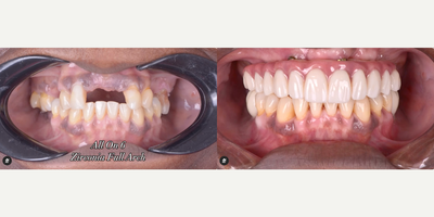 Woman treated with Dental Implants, Smile Makeover - Woman treated with Dental Implants, Smile Makeover