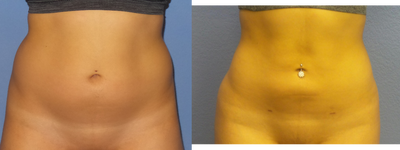 18-24 year old woman treated with Liposuction - 23 y/o female 6 weeks s/p BBL with lipo of abdomen and flanks.